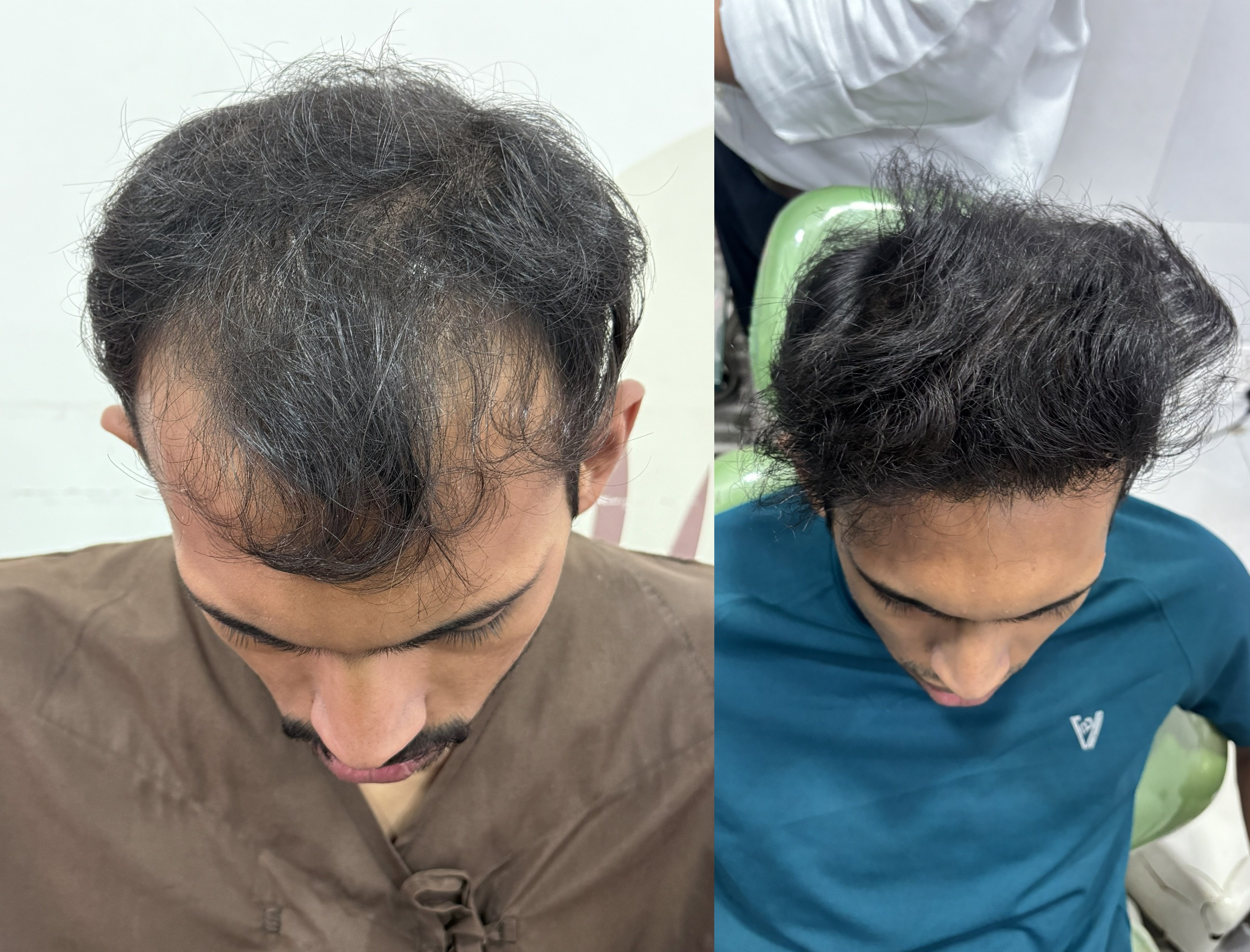 Laser Hair Removal Before and After